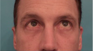 Male Blepharoplasty Patient #1 After Photo Thumbnail # 8