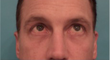 Male Blepharoplasty Patient #1 After Photo # 8