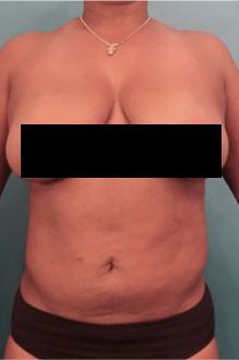 Liposuction Patient #19 After Photo Thumbnail # 2