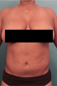 Liposuction Patient