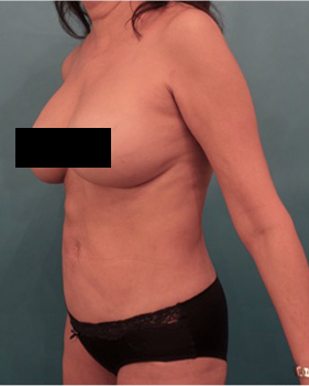 Liposuction Patient #18 After Photo # 4