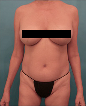 Liposuction Patient #18 Before Photo Thumbnail # 1