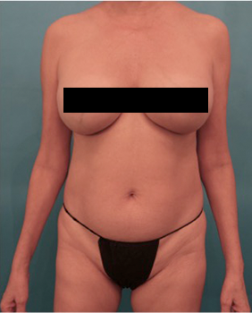 Liposuction Patient