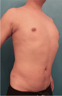 Liposuction Patient #4 After Photo # 8