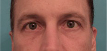Male Blepharoplasty Patient #1 After Photo # 2