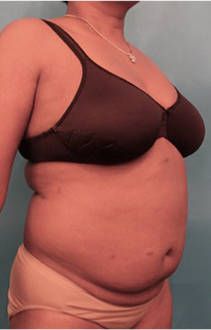 Liposuction Patient #19 Before Photo Thumbnail # 7