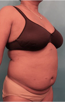 Liposuction Patient #19 Before Photo # 7