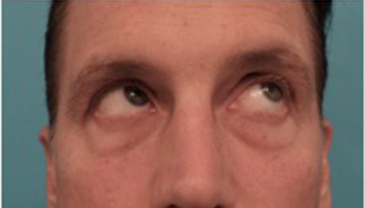 Male Blepharoplasty Patient #1 Before Photo # 9