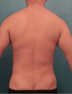 Liposuction Patient #4 After Photo # 4