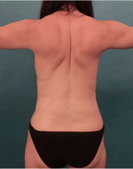 Liposuction Patient #20 After Photo # 6