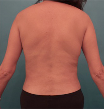 Liposuction Patient #18 After Photo # 6