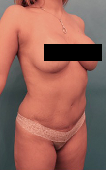 Liposuction Patient #17 Before Photo Thumbnail # 9