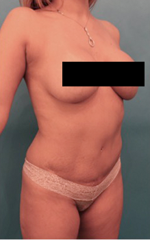 Liposuction Patient #17 Before Photo # 9