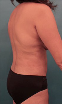 Liposuction Patient #18 After Photo # 8