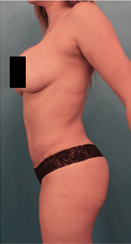 Liposuction Patient