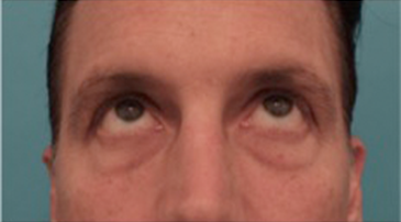 Lower Eyelid Blepharoplasty Patient #1 Before Photo # 7