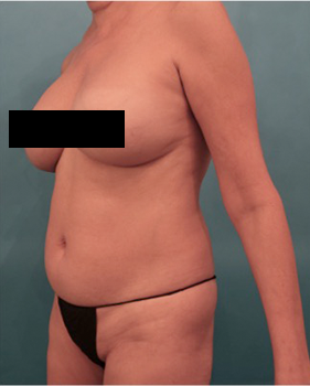 Liposuction Patient #18 Before Photo # 3