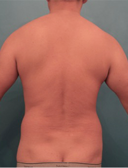 Liposuction Patient #4 Before Photo # 3