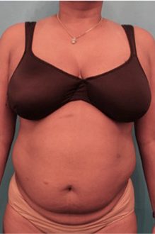 Liposuction Patient #19 Before Photo # 1