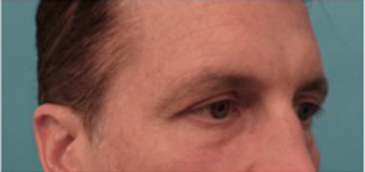 Lower Eyelid Blepharoplasty Patient #1 Before Photo # 5