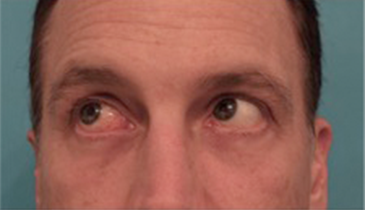 Male Blepharoplasty Patient #1 After Photo # 12