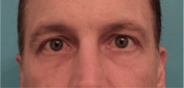 Lower Eyelid Blepharoplasty Patient #1 After Photo # 2