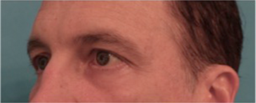 Lower Eyelid Blepharoplasty Patient #1 After Photo Thumbnail # 4