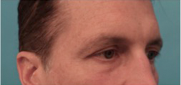 Male Blepharoplasty Patient #1 Before Photo # 5