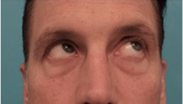 Lower Eyelid Blepharoplasty Patient #1 Before Photo # 9