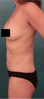 Liposuction Patient #20 After Photo # 8