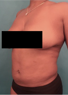 Liposuction Patient #19 After Photo # 4