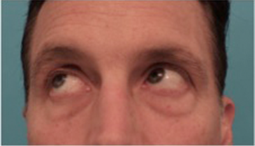 Male Blepharoplasty Patient #1 Before Photo # 11