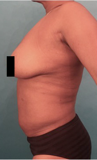 Liposuction Patient #19 After Photo # 6