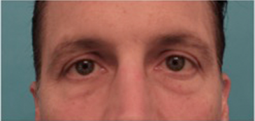Lower Eyelid Blepharoplasty Patient #1 Before Photo # 1