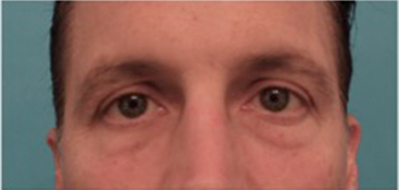 Blepharoplasty (Eyelid Lift) Patient