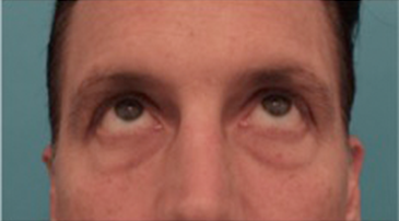 Male Blepharoplasty Patient #1 Before Photo # 7