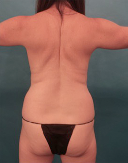 Liposuction Patient #20 Before Photo # 5