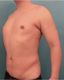 Liposuction Patient #4 After Photo # 2