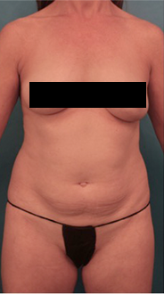 Liposuction Patient #20 Before Photo # 1