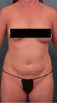 Liposuction Patient