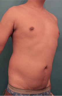 Liposuction Patient #4 Before Photo # 7