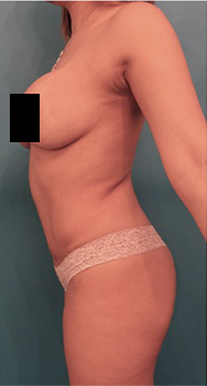 Liposuction Patient #17 Before Photo # 1