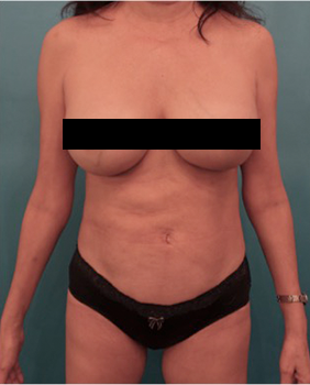 Liposuction Patient #18 After Photo # 2