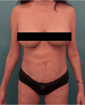 Liposuction Patient