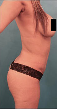 Liposuction Patient #17 After Photo # 8