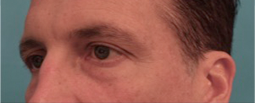 Male Blepharoplasty Patient #1 Before Photo # 3