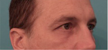 Lower Eyelid Blepharoplasty Patient #1 After Photo # 6