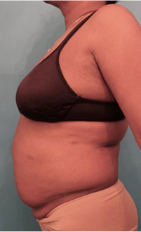 Liposuction Patient #19 Before Photo Thumbnail # 5