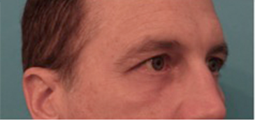 Male Blepharoplasty Patient #1 After Photo # 6