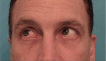 Lower Eyelid Blepharoplasty Patient #1 After Photo # 12